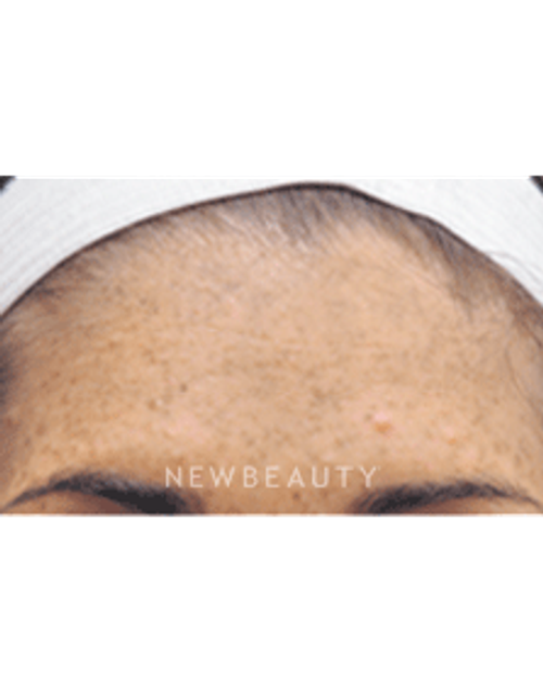 Dr. Jody Levine Lasers, Chemical Peel - Before