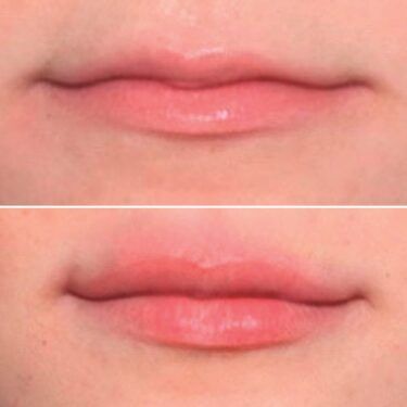 lip flip before and after using filler RHA4