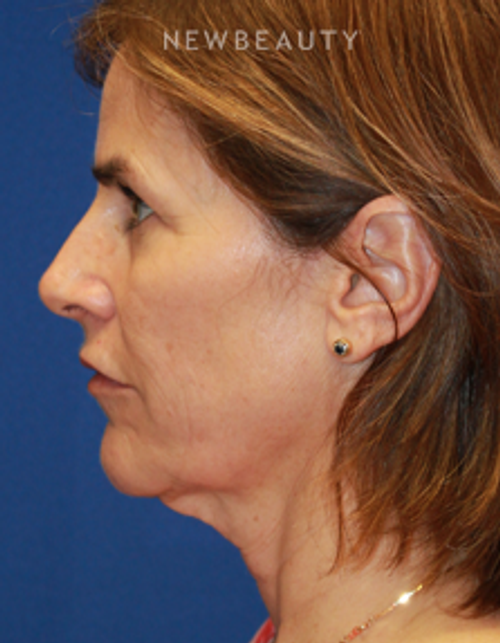 Dr. Dilip Madnani - Facelift - Before