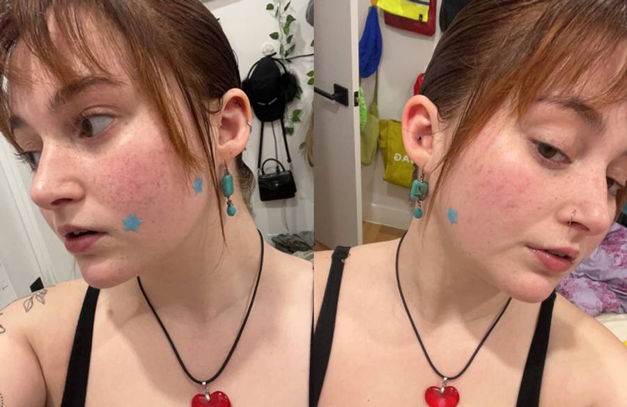 pimple patches