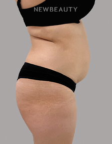 Dr. Daniel Crane – Liposuction - 46167241 - Before