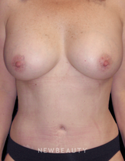 Dr. Carmen Kavali Breast Augmentation, Implants, Liposuction, Mommy Makeover, Tummy Tuck - After