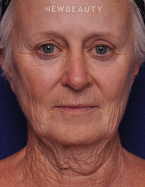 Dr. Alan Durkin - Limited Incision Facelift - Before