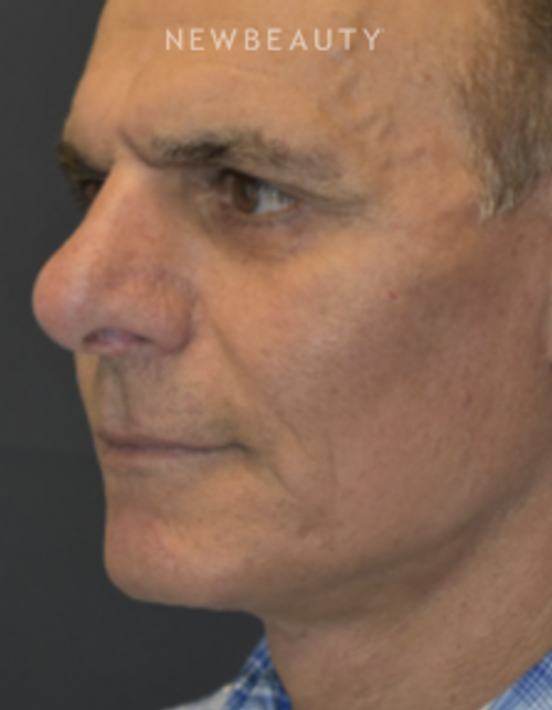 Drs. Lieberman & Parikh - Signature Facelift - After