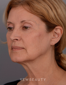 Dr. Matthew White  - Facelift - Before