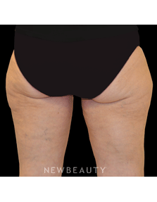 Dr. Julie Russak - CoolSculpting - Before