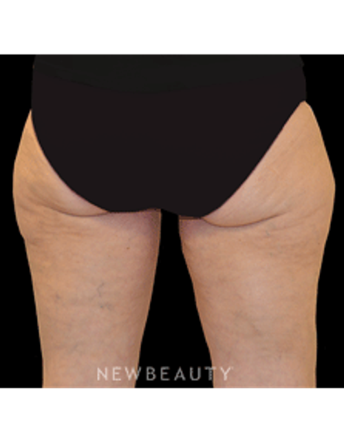 Dr. Julie Russak - CoolSculpting - Before