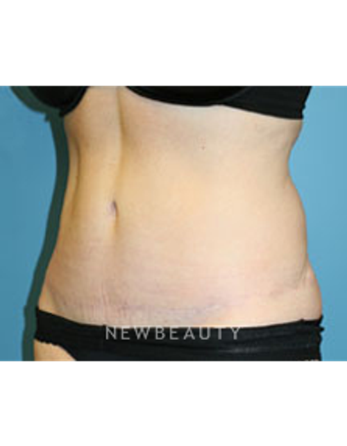 Dr. Christine Hamori - Tummy Tuck - After