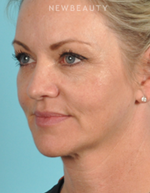 Dr. Bradley Bengtson - Injectables & Fillers - After