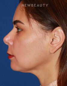 Dr. Dilip D. Madnani - Mini-Facelift - Before