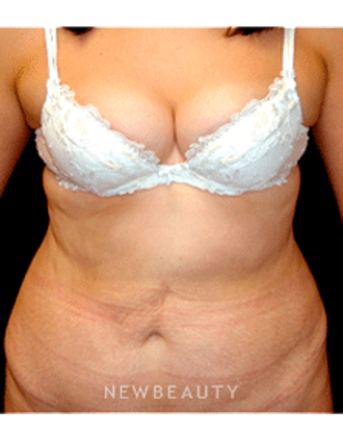 Dr. Mokhtar Asaadi Tummy Tuck - Before