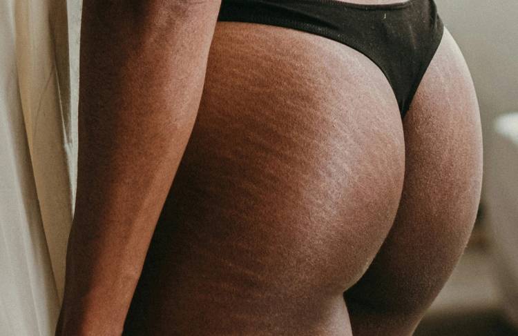 At-Home Products for Fading Stretch Marks
