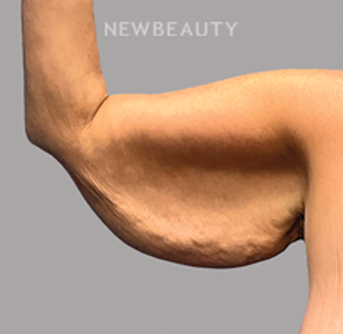 DR.PHILIPPE A.CAPRARO - Arm Lift - 46190990 - Before