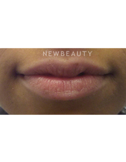 Dr. Kally Papantoniou - Volumizing Lips - Before