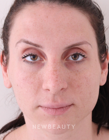 Dr. Julie Russak - Botox - After