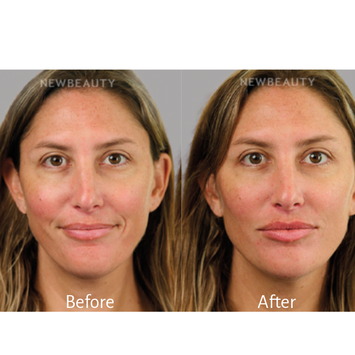 Dr. Deborah Longwill lip, cheek and chin filler