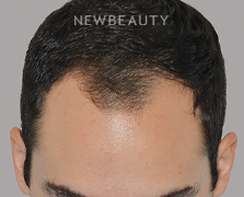 Dr. Anthony Bared - Hair Transplant - 46164621 - Before