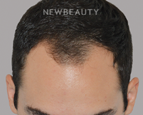 Dr. Anthony Bared - Hair Transplant - 46164621 - Before