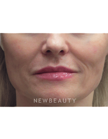 Dr. Jody Levine Injectables & FIllers - After