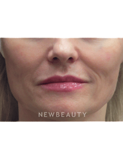 Dr. Jody Levine Injectables & FIllers - After