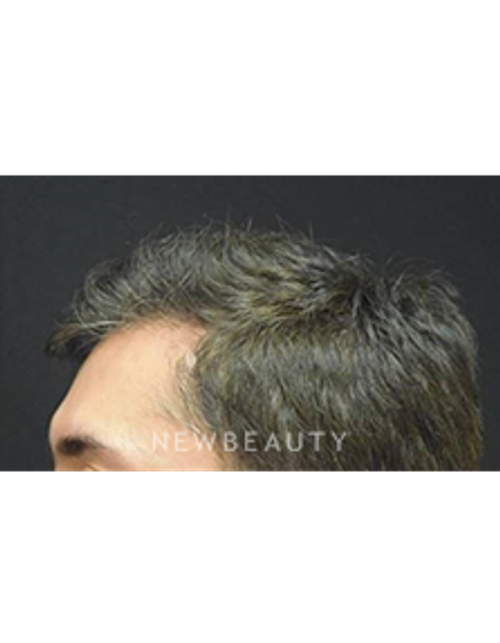 Dr. Jeffrey B. Wise - Hair Loss Treatment - After