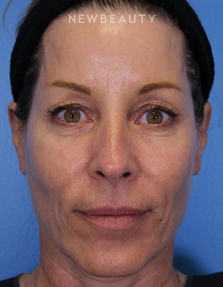Dr. Ava Shamban - Full Facial Rejuvenation - After