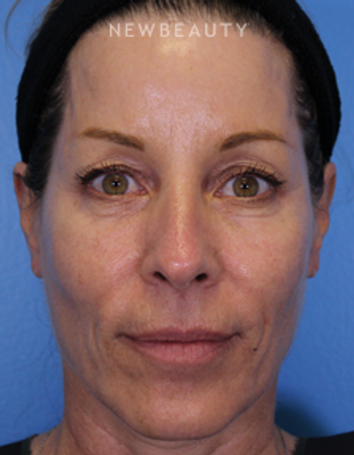 Dr. Ava Shamban - Full Facial Rejuvenation - After