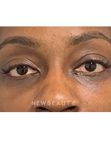 Dr. Dilip Madnani - Lower Blepharoplasty - 13691829 - After