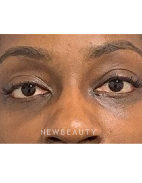 Dr. Dilip Madnani - Lower Blepharoplasty - 13691829 - After