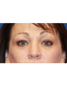 Dr. Dilip Madnani - Upper Blepharoplasty - Before