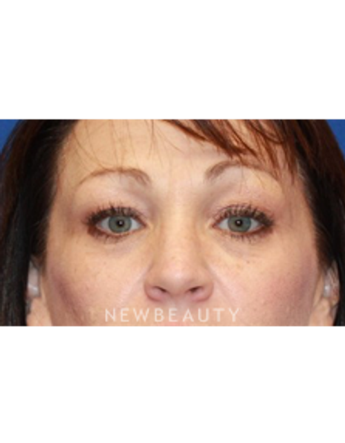 Dr. Dilip Madnani - Upper Blepharoplasty - Before