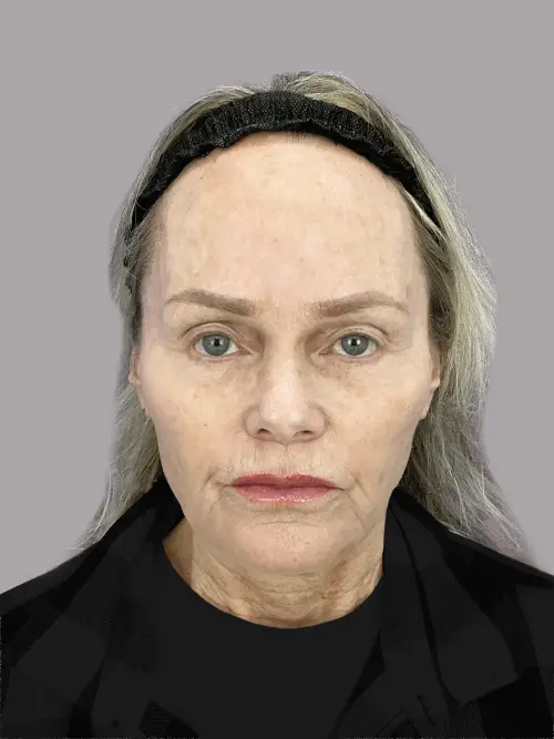 Dr. Sheila Barbarino-Laser-54798830 - After