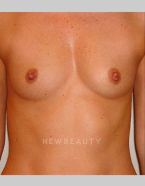 Dr. Michael Horn Silicone Breast Implants - Before