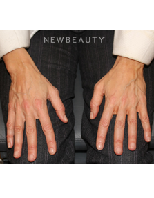 Dr. Dilip Madnani - Radiesse - 13690858 - Before