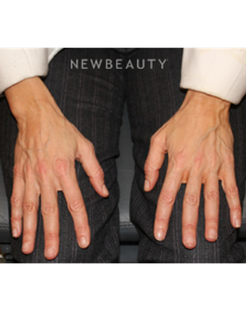 Dr. Dilip Madnani - Radiesse - 13690858 - Before