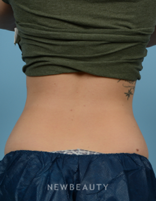 Dr. Jeffrey Wise - CoolSculpting - After
