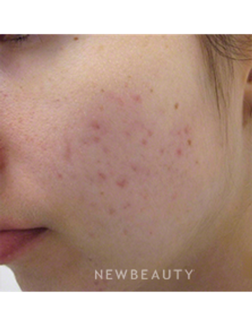 Dr. Kally Papantoniou - Acne Treatment - Before