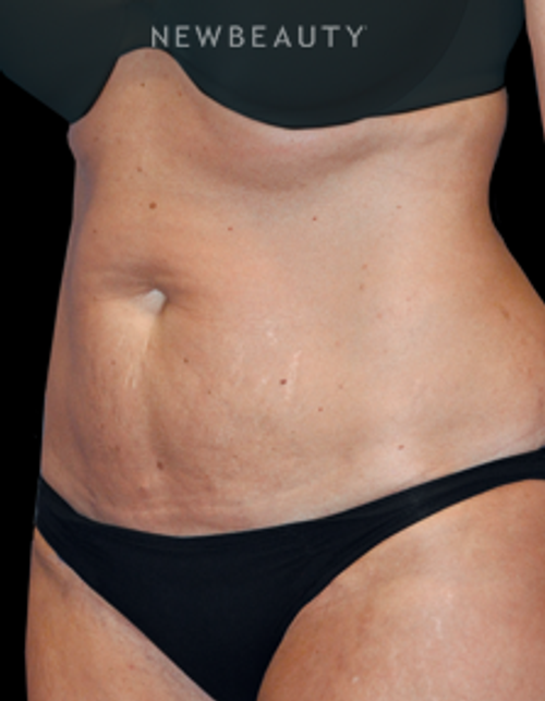 Dr. Bryan W. Gawley - Tummy Tuck with Lipo - Before