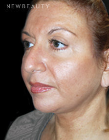 Dr. Roman Rayham - Youthful Restoration - After