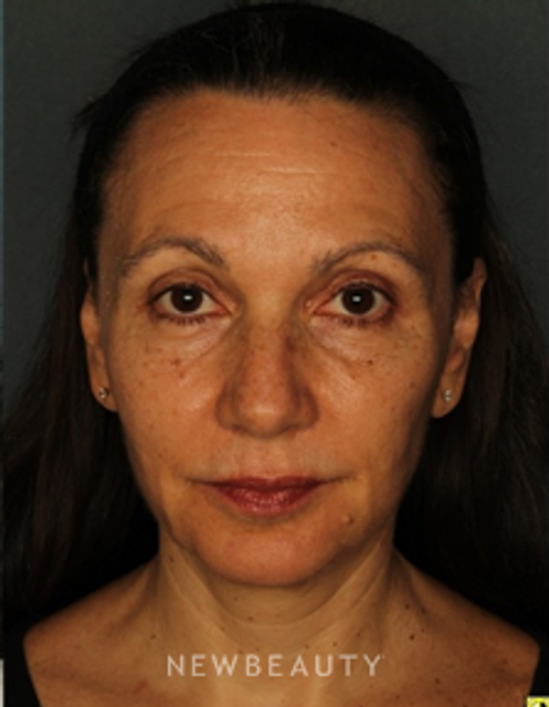 Dr. Doris Day - Injectables & Fillers, Chemical Peel & Skin Tighteners - After