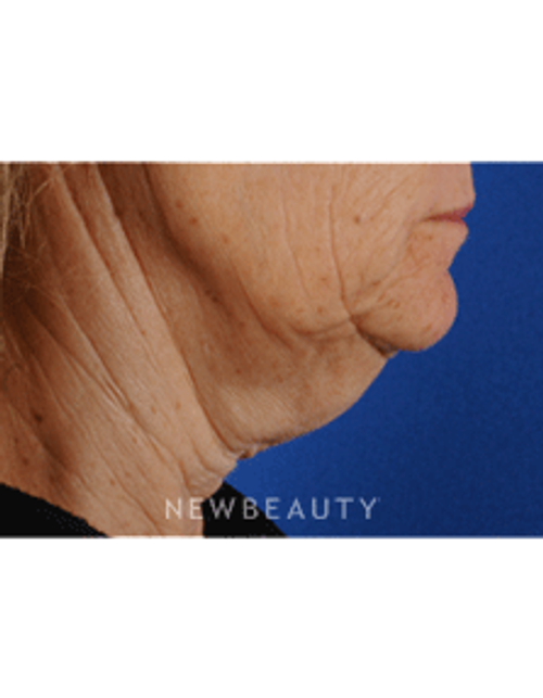 Dr. Gilly Munavalli Liposuction - Before