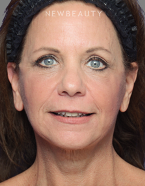 Dr. Alan Durkin - Facelift with Fat Transfer - After