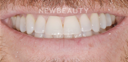 Dr. Salvator La Mastra - Smile Makeover -46107468 - Before