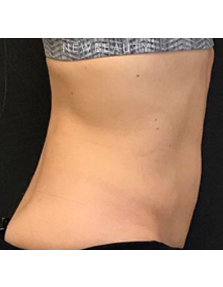 Dr. Janet Allenby - EmSculpt - After