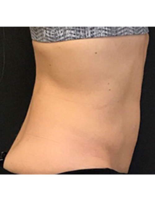 Dr. Janet Allenby - EmSculpt - After