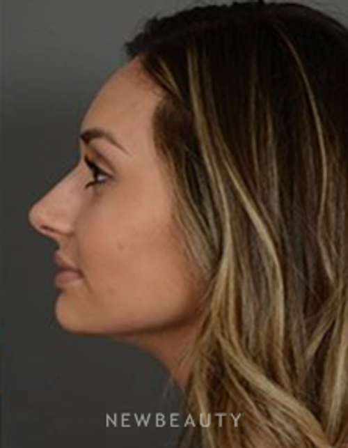 Dr. David Kim - Rhinoplasty - After