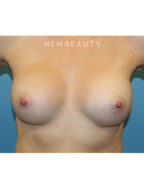 Dr. Christine Hamori - Larger Bust - After