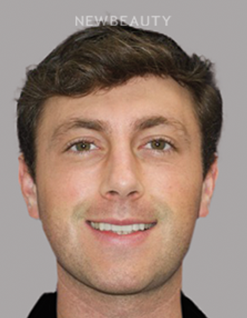 Dr. Salvator La Mastra - Smile Makeover -46108507 - Before