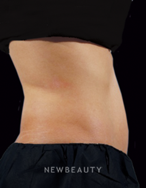 Dr. Marina Peredo - CoolSculpting - After