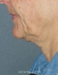 Dr. Min Ahn - Necklift - Before